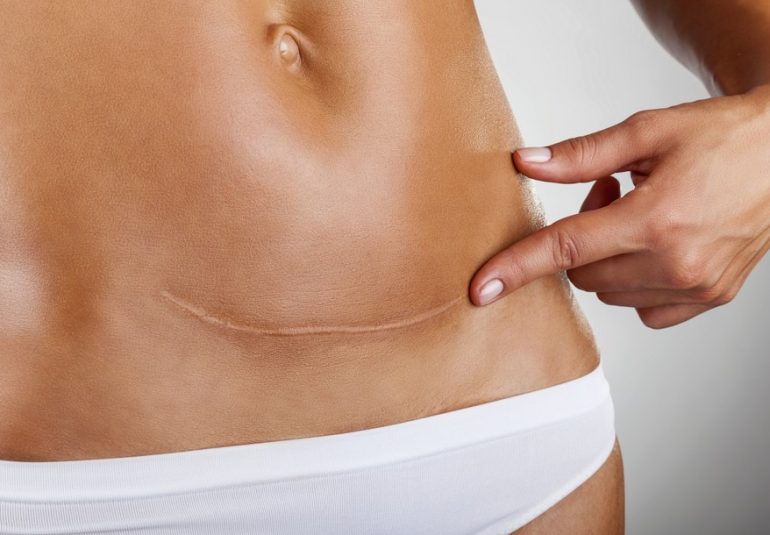 cicatrização cirurgia plastica