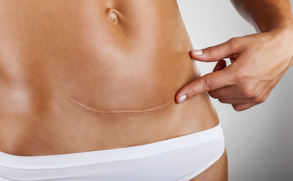cicatrização cirurgia plastica