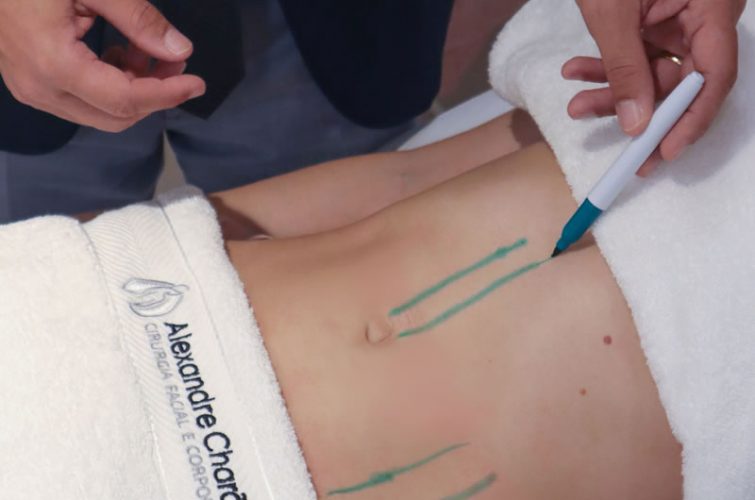 lipoaspiração rio de janeiro cirurgia plástica