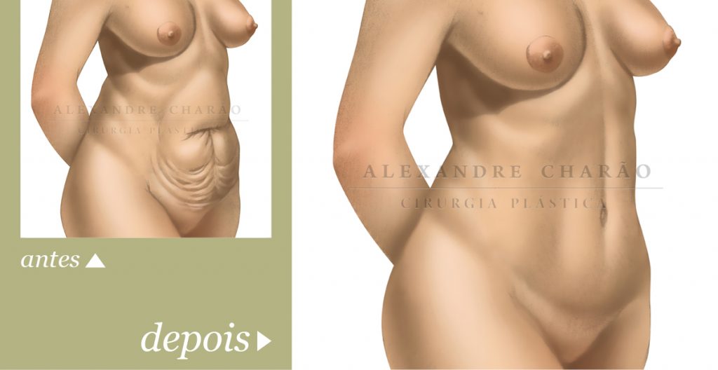 Guia da Abdominoplastia2