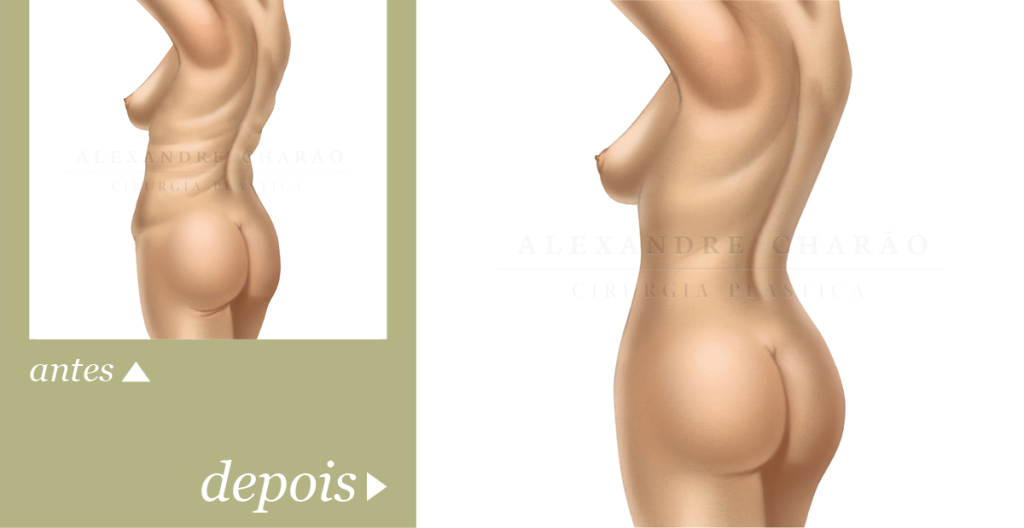Lipoaspiração