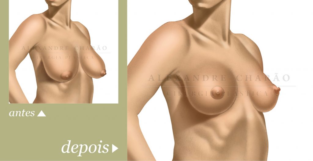 mamoplastia antes e depois