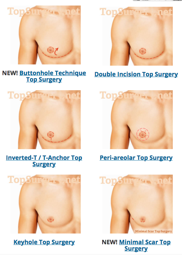 mamoplastia redutora