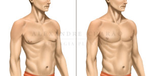 cirurgia de ginecomastia masculina no rio de janeiro