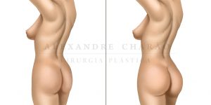 gluteoplastia - antes e depois
