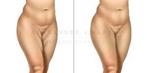 lifiting coxas - antes e depois
