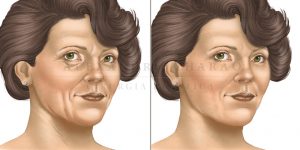 lifting facial - antes e depois