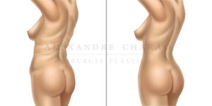 lipoaspiracao - antes e depois