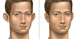 otoplastia - antes e depois