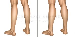 protese de panturrilha - antes e depois