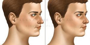rinoplastia - antes e depois