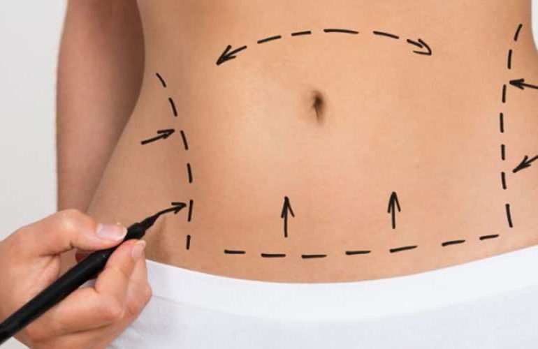 cirurgia de abdominoplastia no rio de janeiro plastica do abdomen