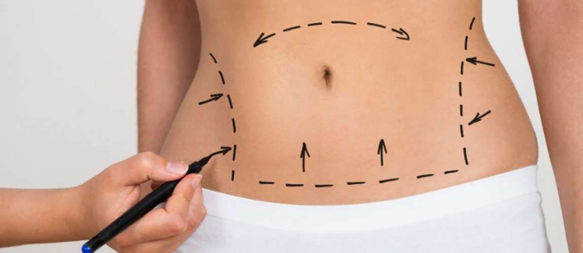 cirurgia de abdominoplastia no rio de janeiro plastica do abdomen