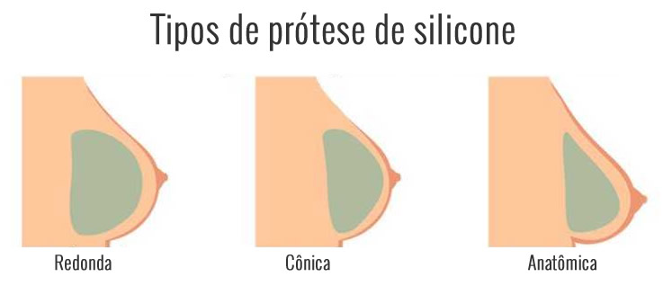 tipos de silicone RJ