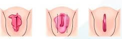 ninfoplastia rio de janeiro