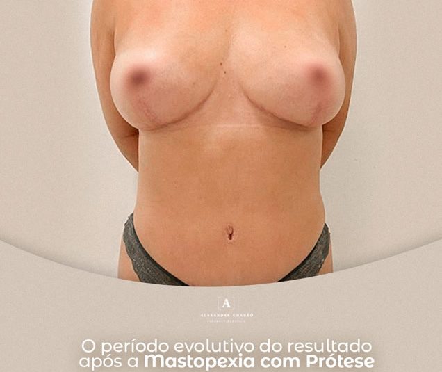 Mastopexia com Prótese no Rio de Janeiro Como é o período evolutivo