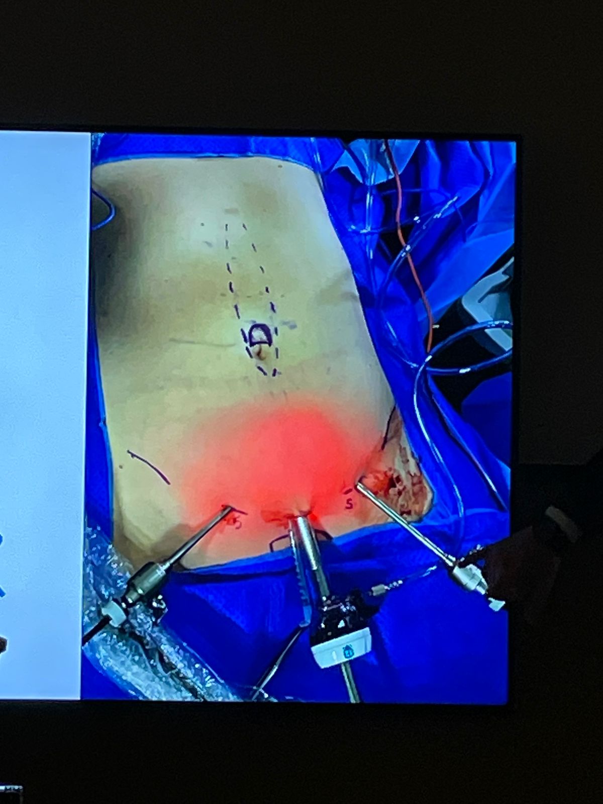 Lipoabdominoplastia Minimamente Invasiva (M.I.L.A)
