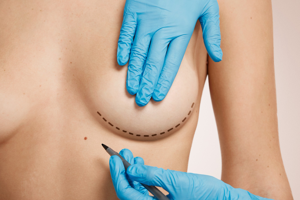 mastopexia no rio de janeiro cirurgia plástica